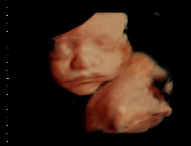 3D ultrasound image at 29 weeks